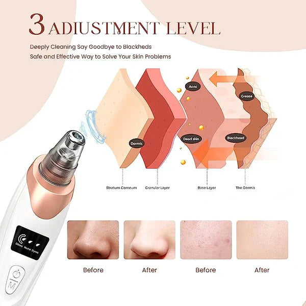 Electric Blackhead Remover - Dwellus